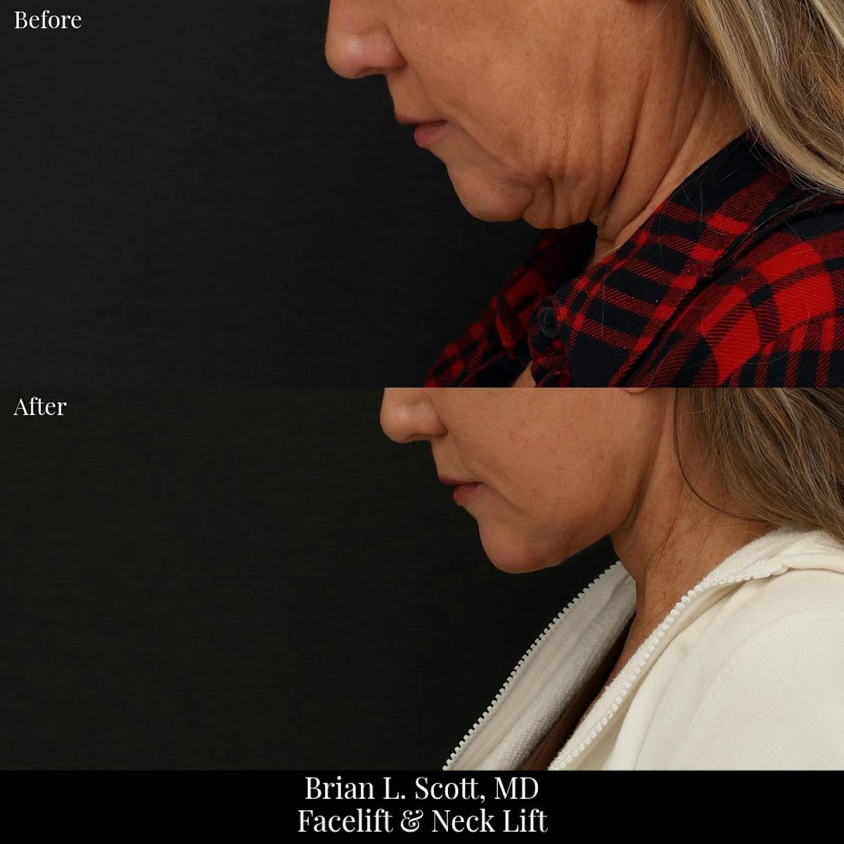 Facelift Before & After Gallery - Patient 336709 - Image 2