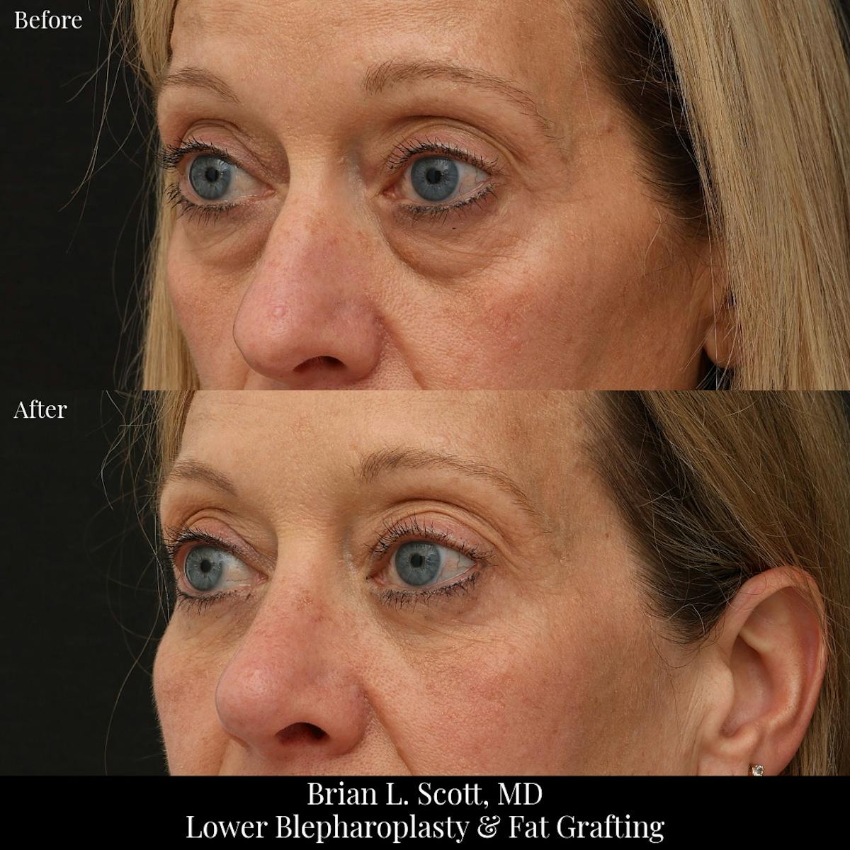 Lower Blepharoplasty Before & After Gallery - Patient 377874 - Image 2