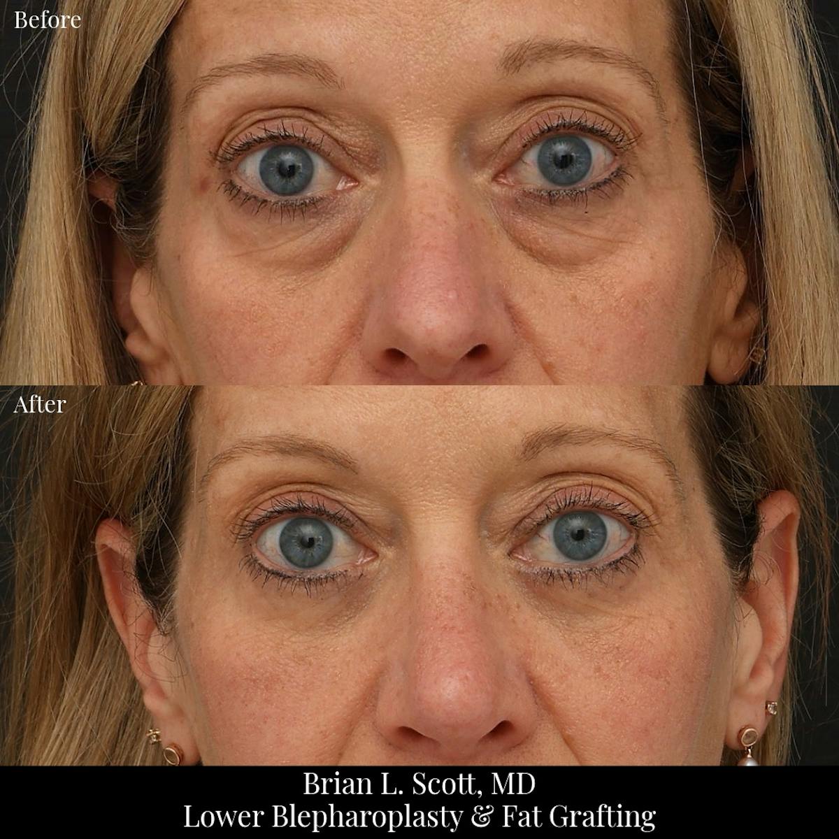 Lower Blepharoplasty Before & After Gallery - Patient 377874 - Image 1