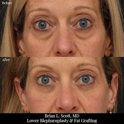 Lower Blepharoplasty Before & After Gallery - Patient 377874 - Image 1