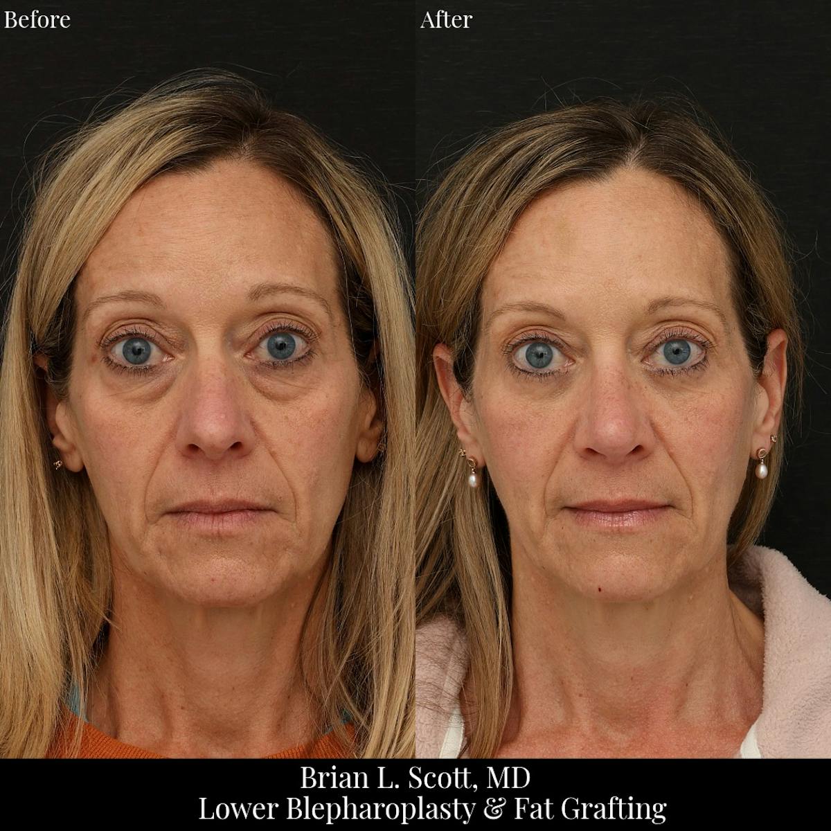Lower Blepharoplasty Before & After Gallery - Patient 377874 - Image 3