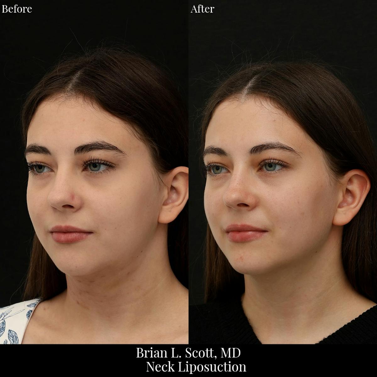 Neck Liposuction Before & After Gallery - Patient 401600 - Image 2