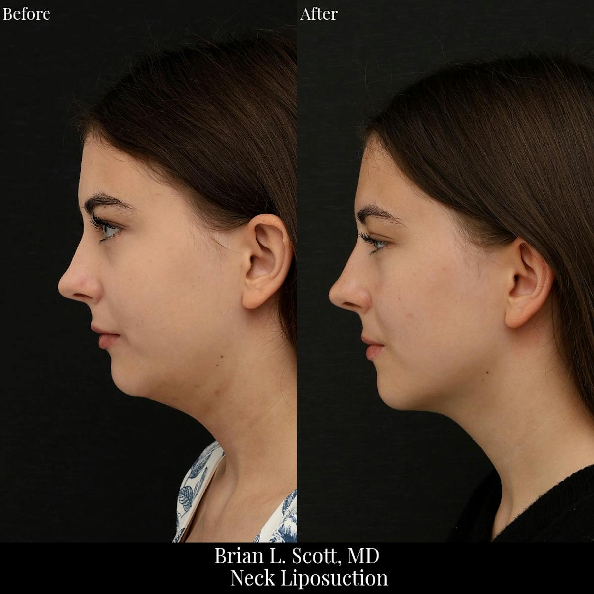 Neck Liposuction Before & After Gallery - Patient 401600 - Image 1
