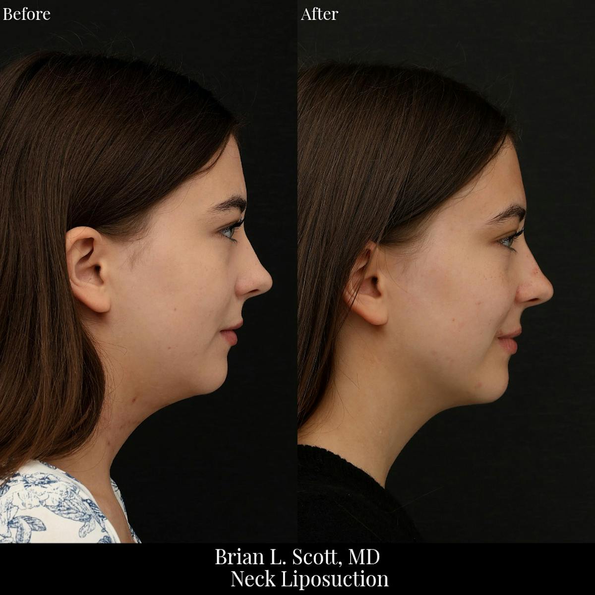 Neck Liposuction Before & After Gallery - Patient 401600 - Image 3