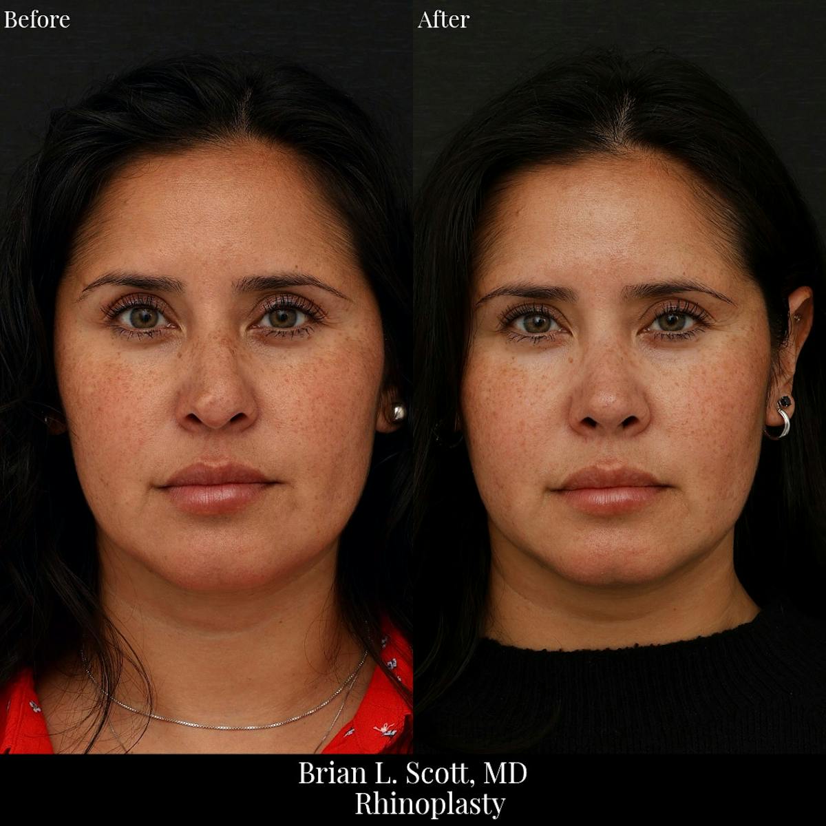 Rhinoplasty Before & After Gallery - Patient 178761 - Image 3