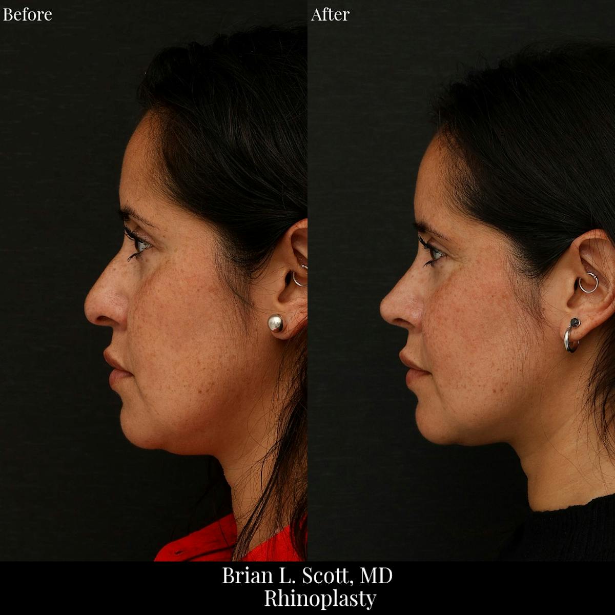 Rhinoplasty Before & After Gallery - Patient 178761 - Image 1
