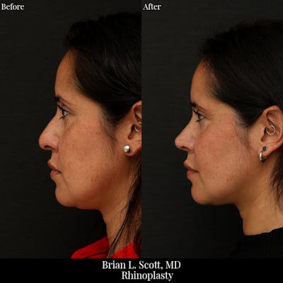 Rhinoplasty Before & After Gallery - Patient 178761 - Image 1