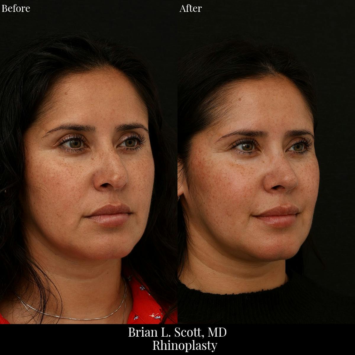 Rhinoplasty Before & After Gallery - Patient 178761 - Image 2