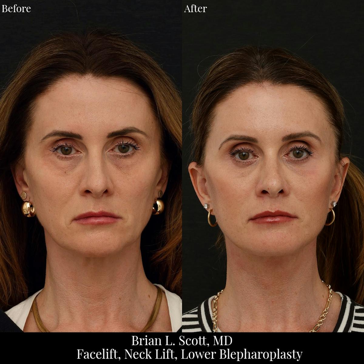 Neck Lift Before & After Gallery - Patient 271853 - Image 3