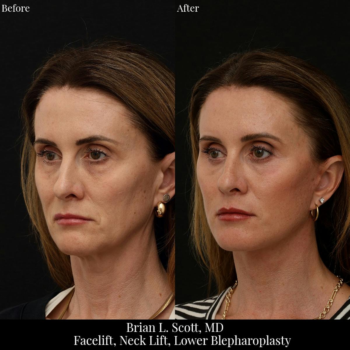 Neck Lift Before & After Gallery - Patient 271853 - Image 2