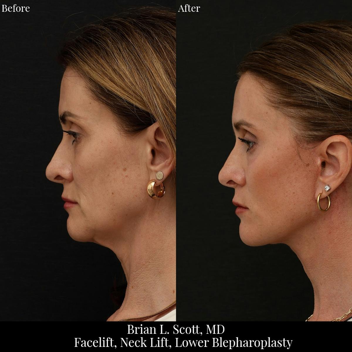 Neck Lift Before & After Gallery - Patient 271853 - Image 5