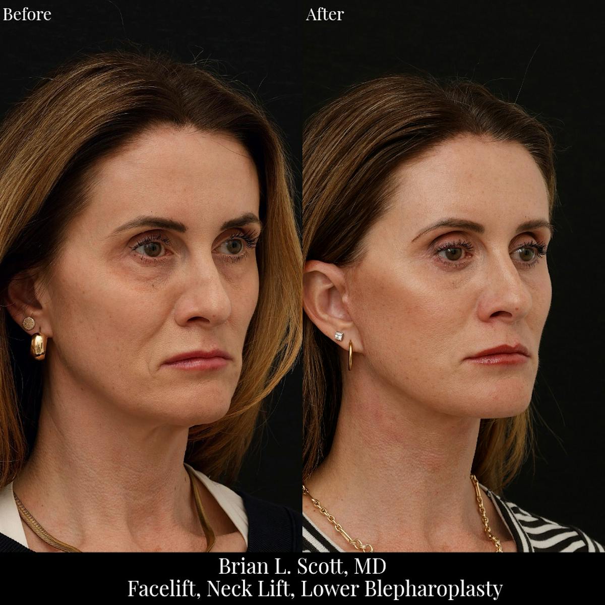 Neck Lift Before & After Gallery - Patient 271853 - Image 1