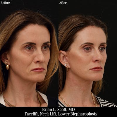 Neck Lift Before & After Gallery - Patient 271853 - Image 1