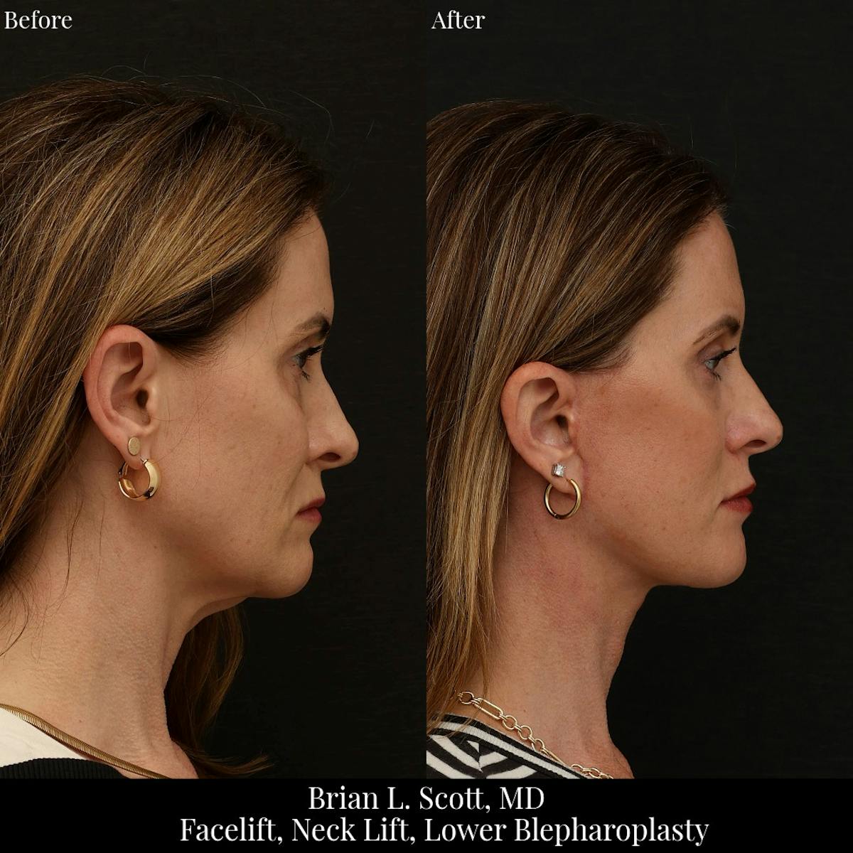 Neck Lift Before & After Gallery - Patient 271853 - Image 4