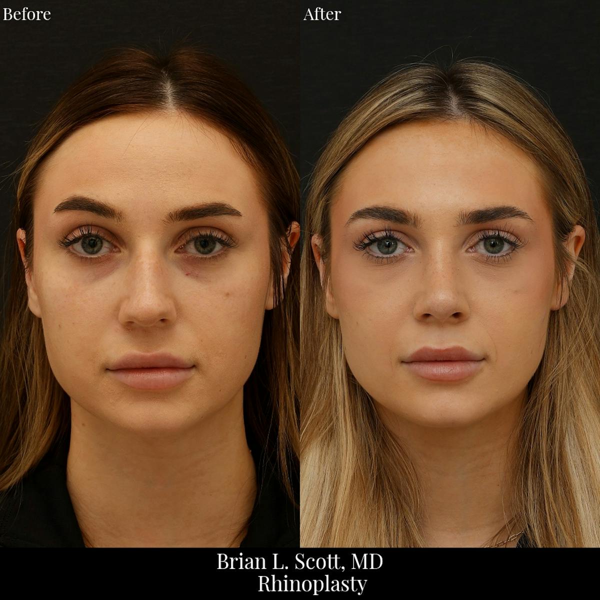Rhinoplasty Before & After Gallery - Patient 387215 - Image 3