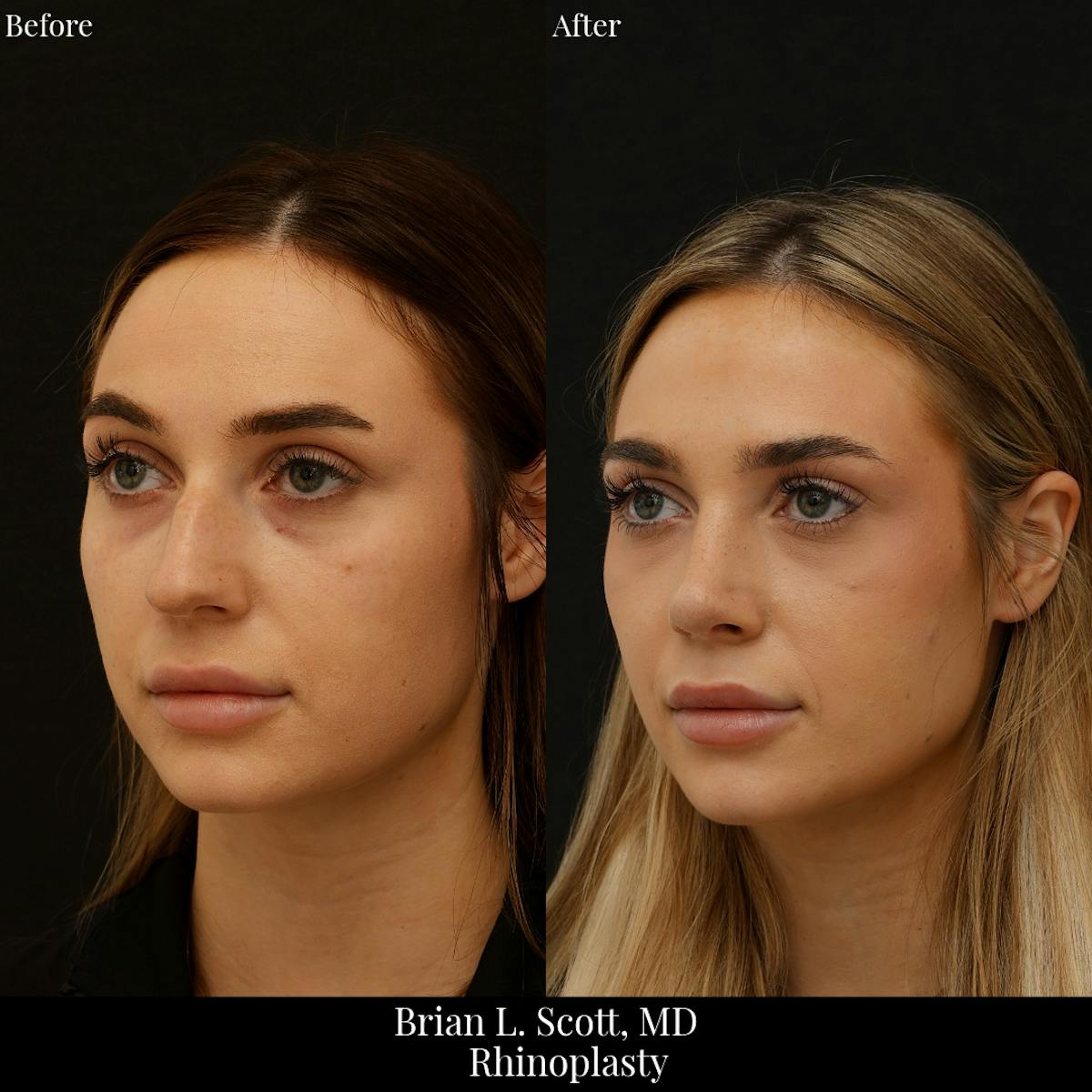 Rhinoplasty Before & After Gallery - Patient 387215 - Image 2