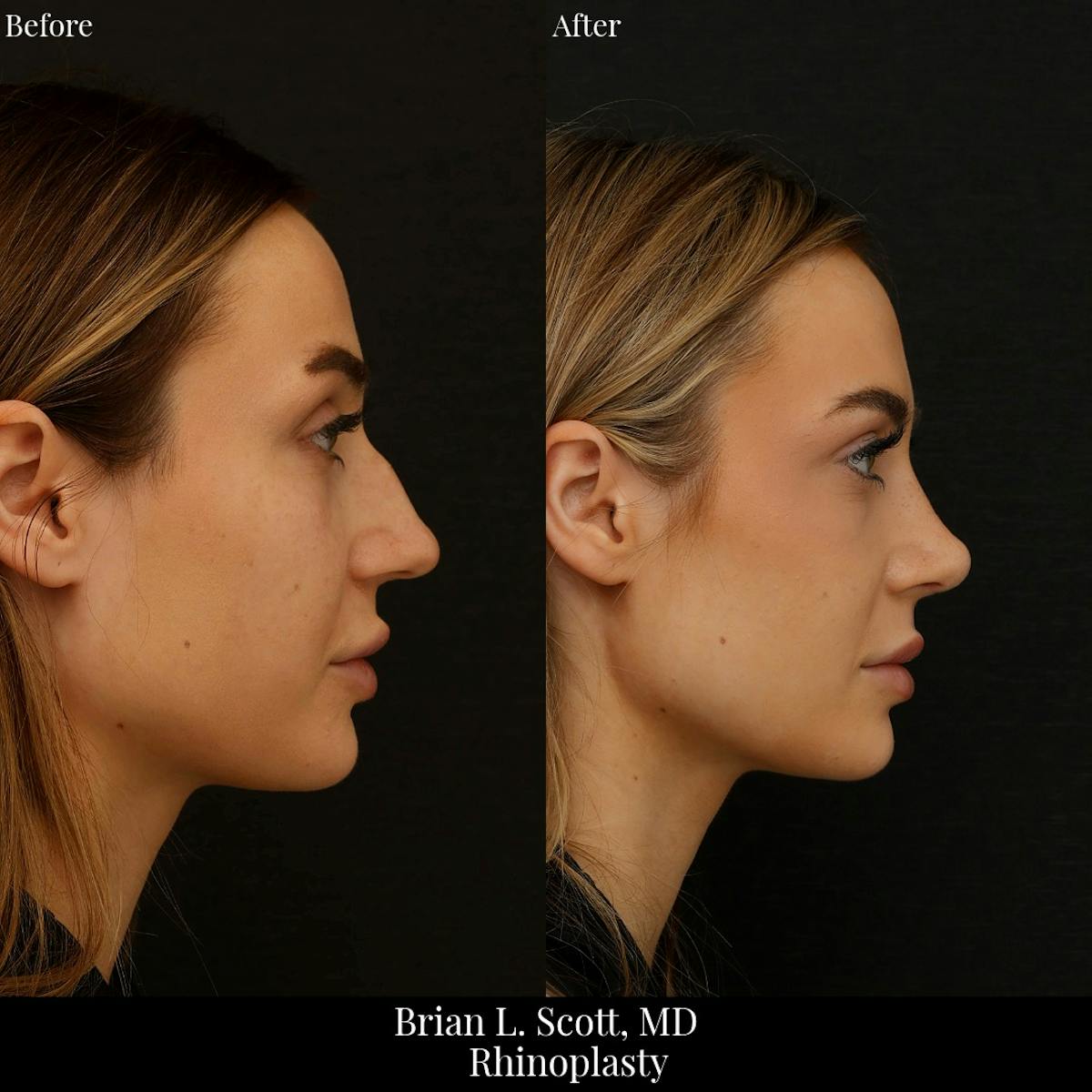 Rhinoplasty Before & After Gallery - Patient 387215 - Image 1