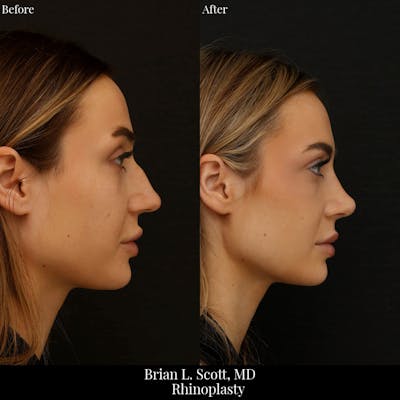 Rhinoplasty Before & After Gallery - Patient 387215 - Image 1