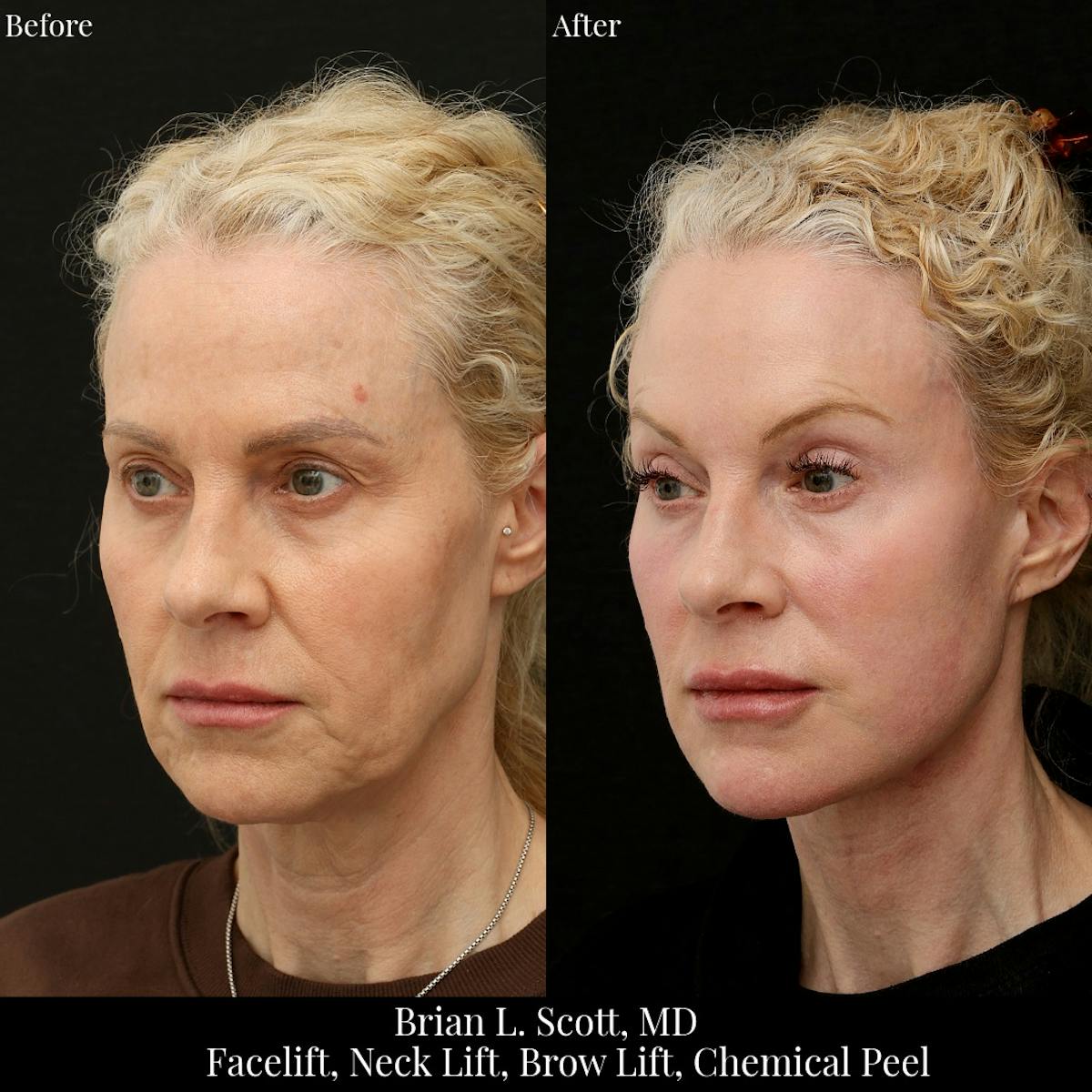 Brow Lift Before & After Gallery - Patient 425801 - Image 2