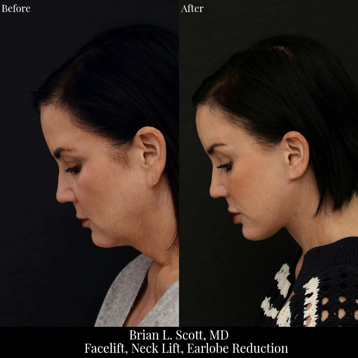 Facelift Before & After Gallery - Patient 155624 - Image 1