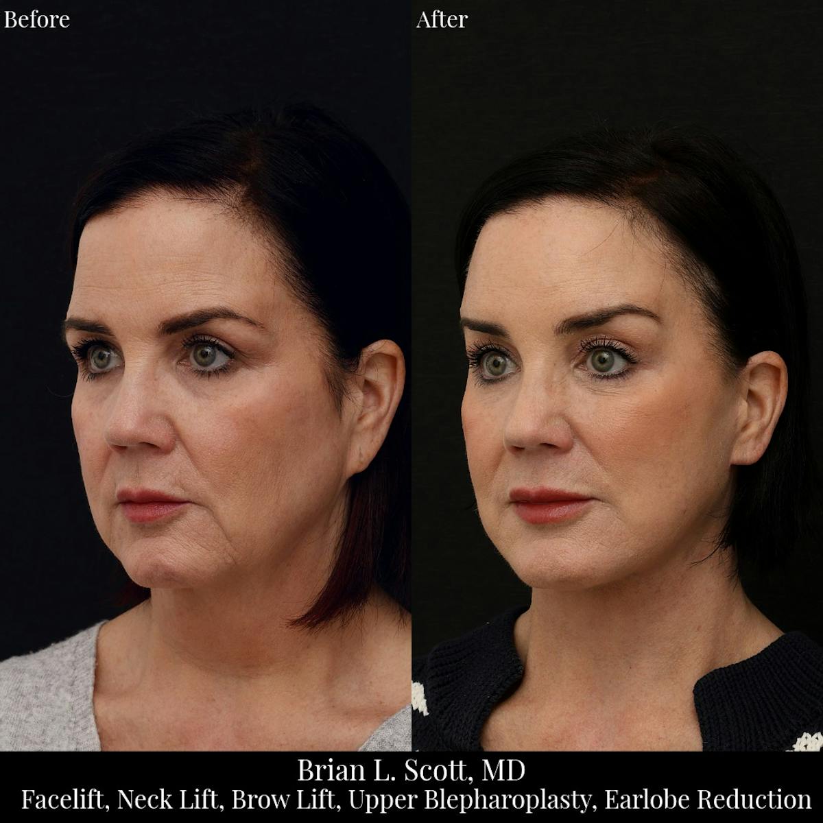 Facelift Before & After Gallery - Patient 155624 - Image 2