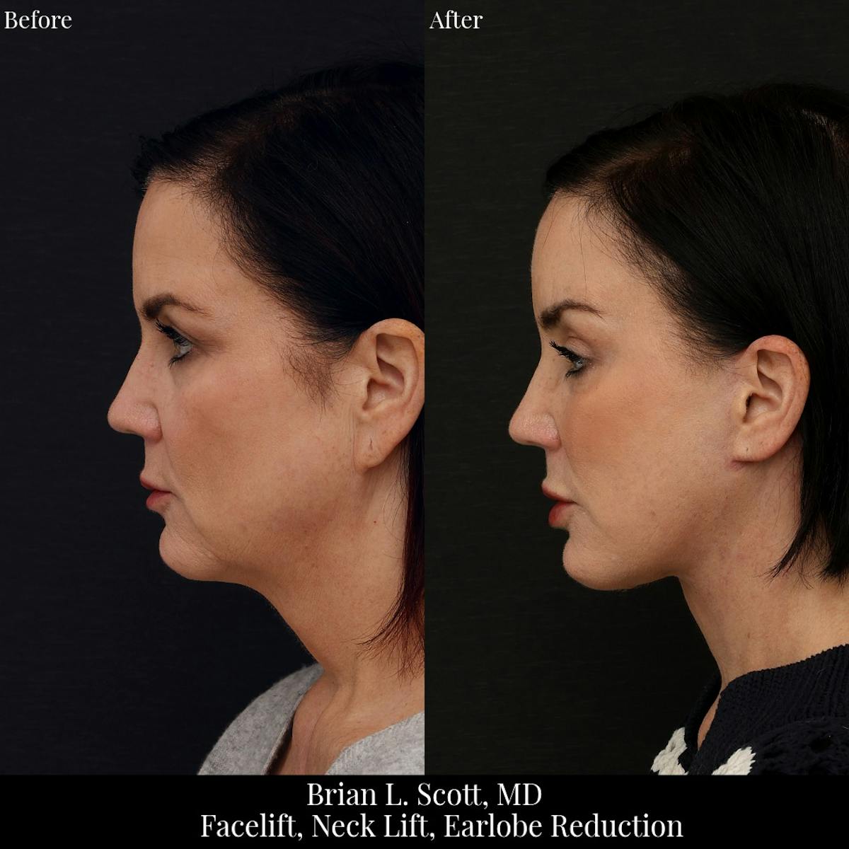 Facelift Before & After Gallery - Patient 155624 - Image 4