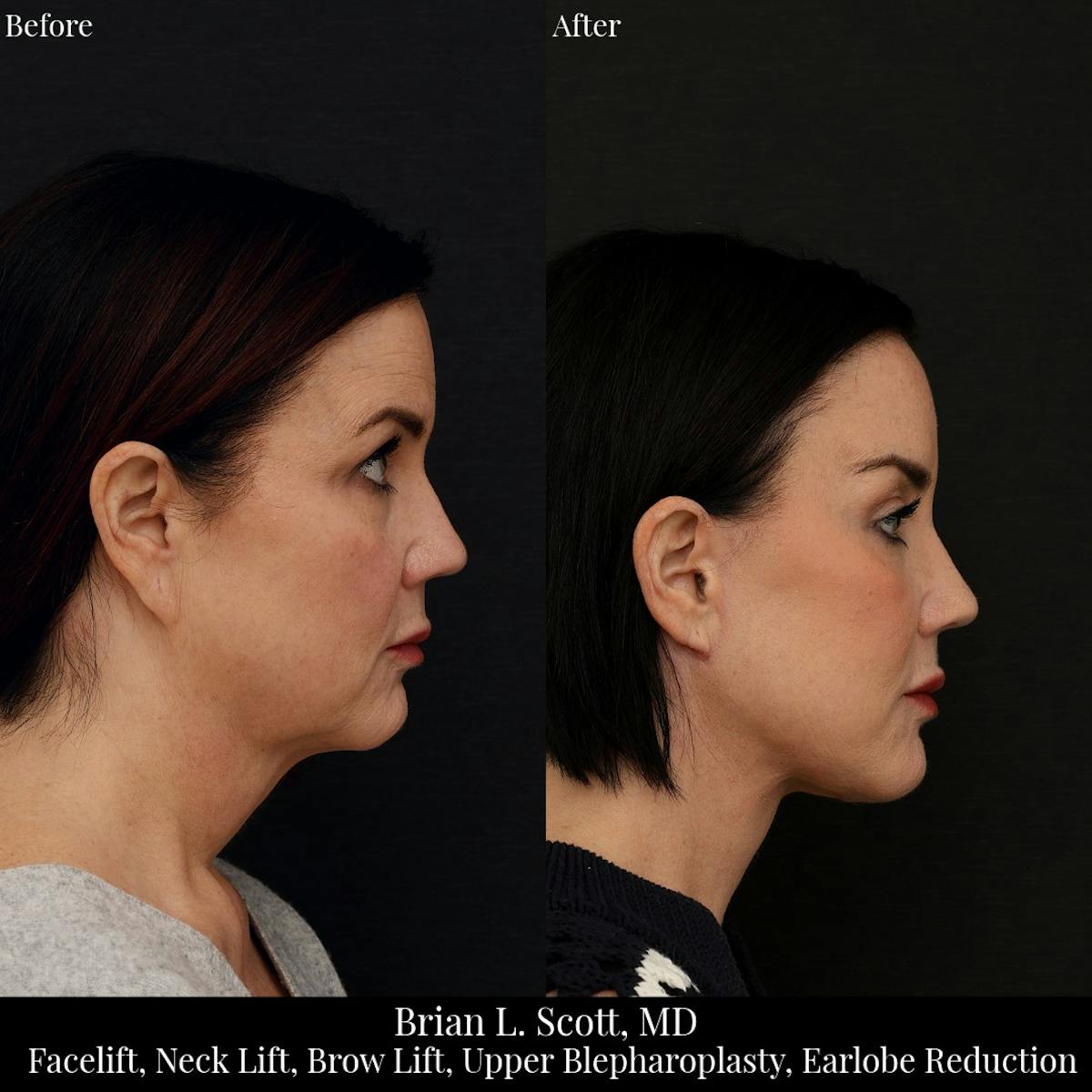 Facelift Before & After Gallery - Patient 155624 - Image 3