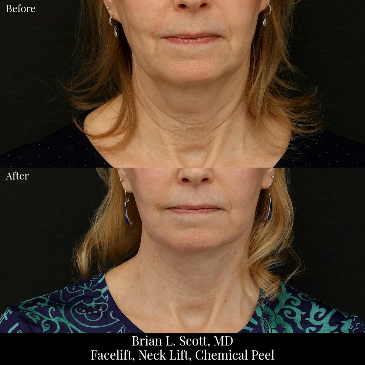 Facelift Before & After Gallery - Patient 376428 - Image 4