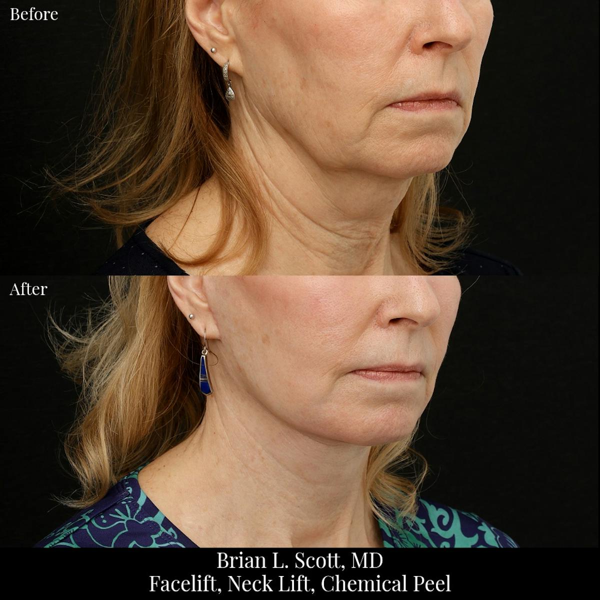 Facelift Before & After Gallery - Patient 376428 - Image 1