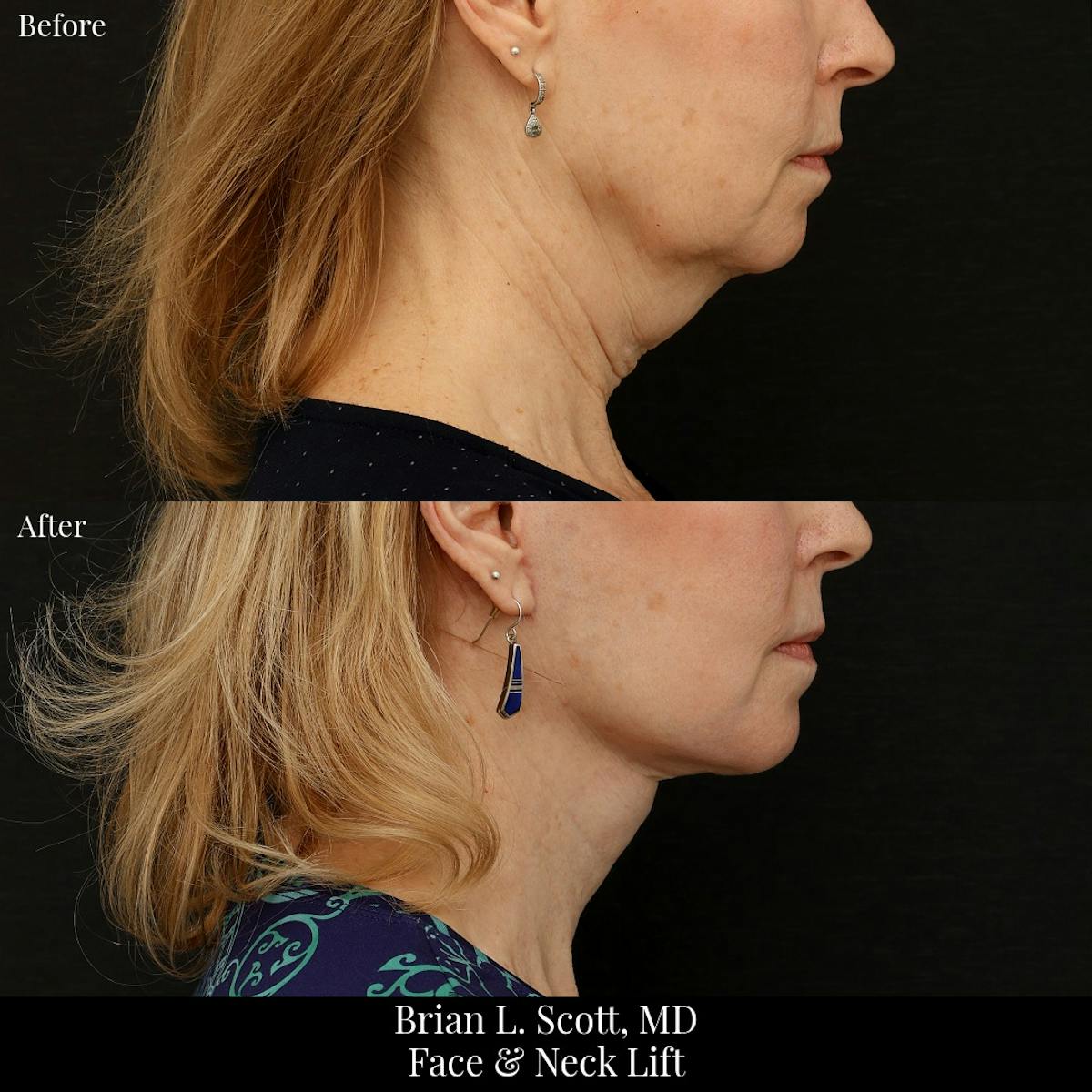 Facelift Before & After Gallery - Patient 376428 - Image 2
