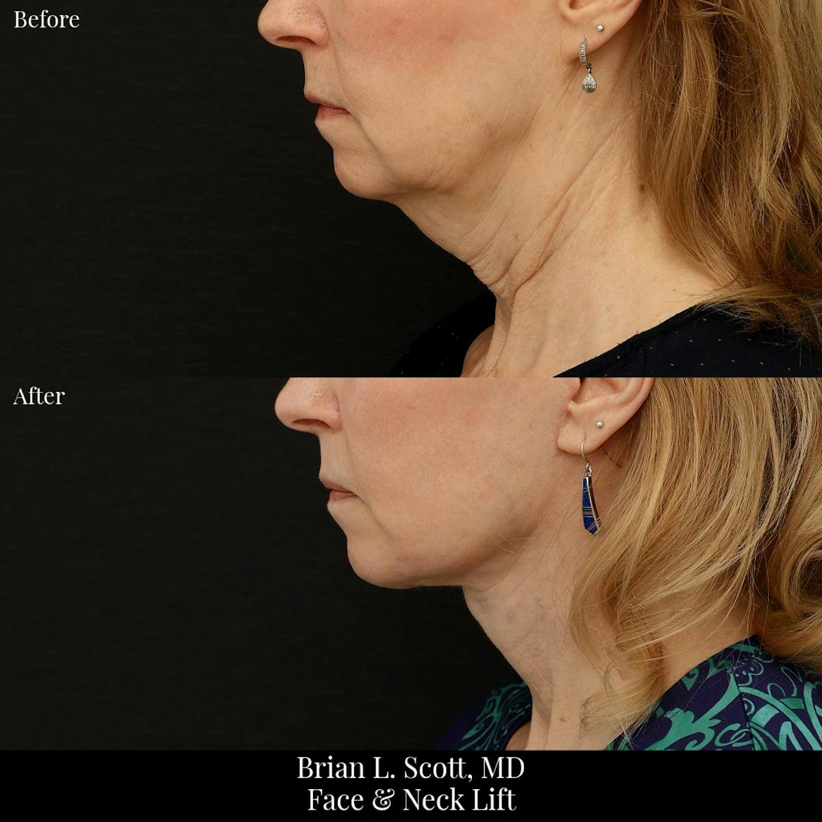 Facelift Before & After Gallery - Patient 376428 - Image 3