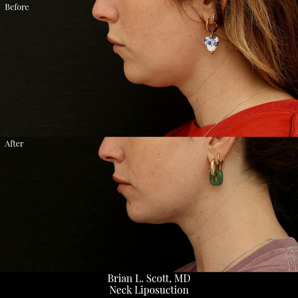 Neck Liposuction Before & After Gallery - Patient 198892 - Image 1