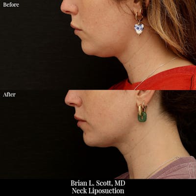 Neck Liposuction Before & After Gallery - Patient 198892 - Image 1