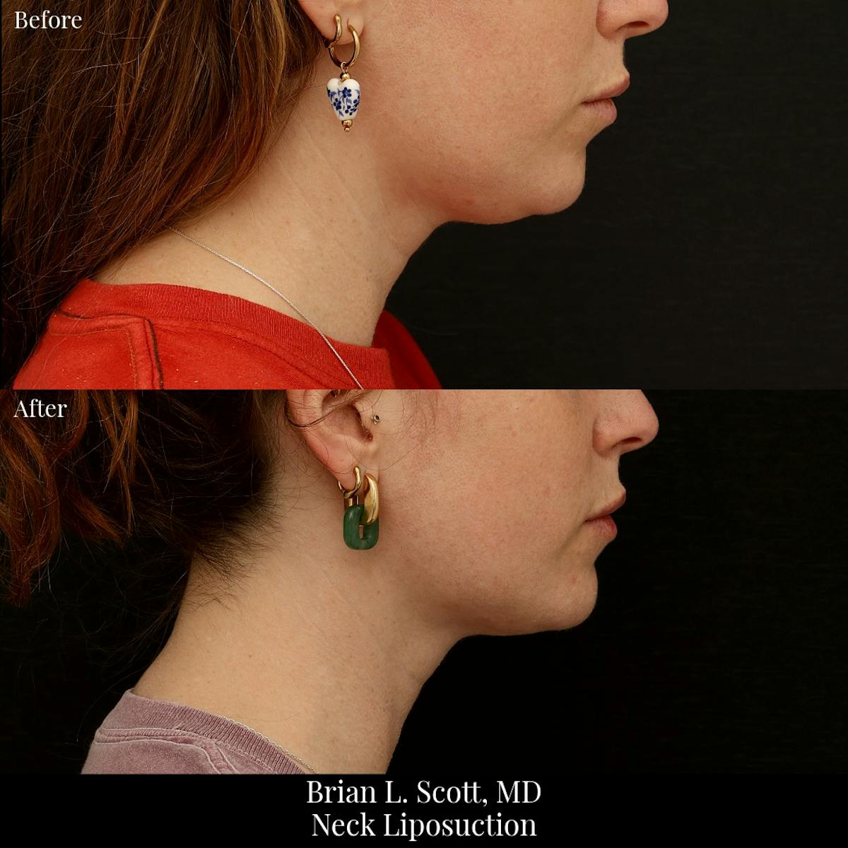 Neck Liposuction Before & After Gallery - Patient 198892 - Image 2