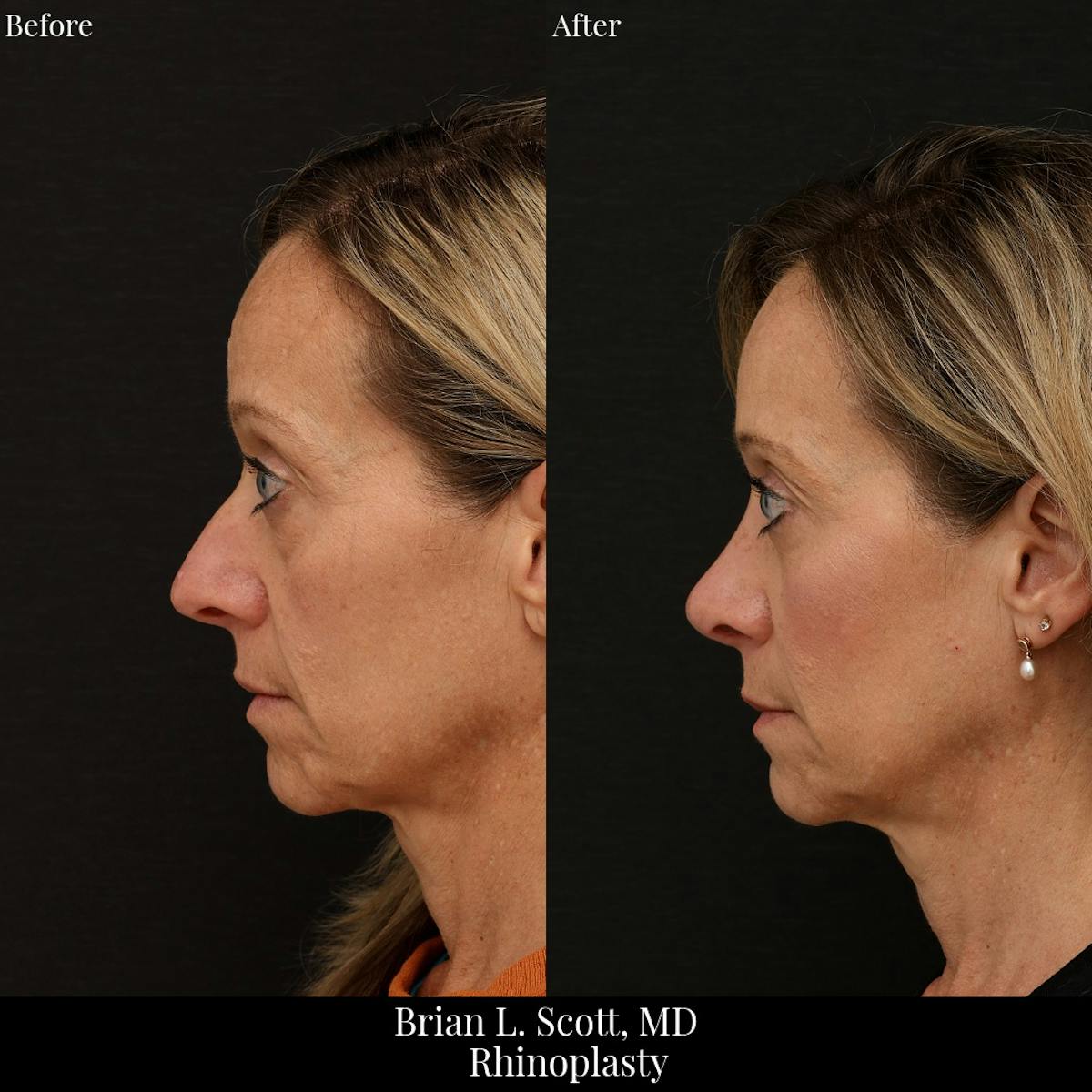 Rhinoplasty Before & After Gallery - Patient 375319 - Image 1