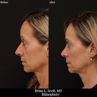 Rhinoplasty Before & After Gallery - Patient 375319 - Image 1