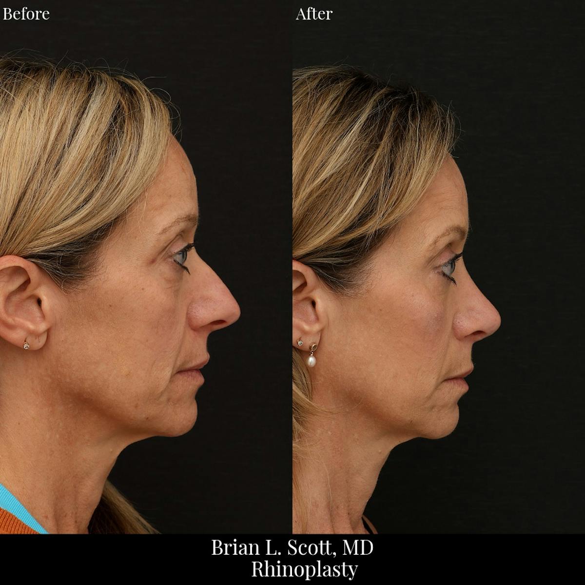 Rhinoplasty Before & After Gallery - Patient 375319 - Image 3