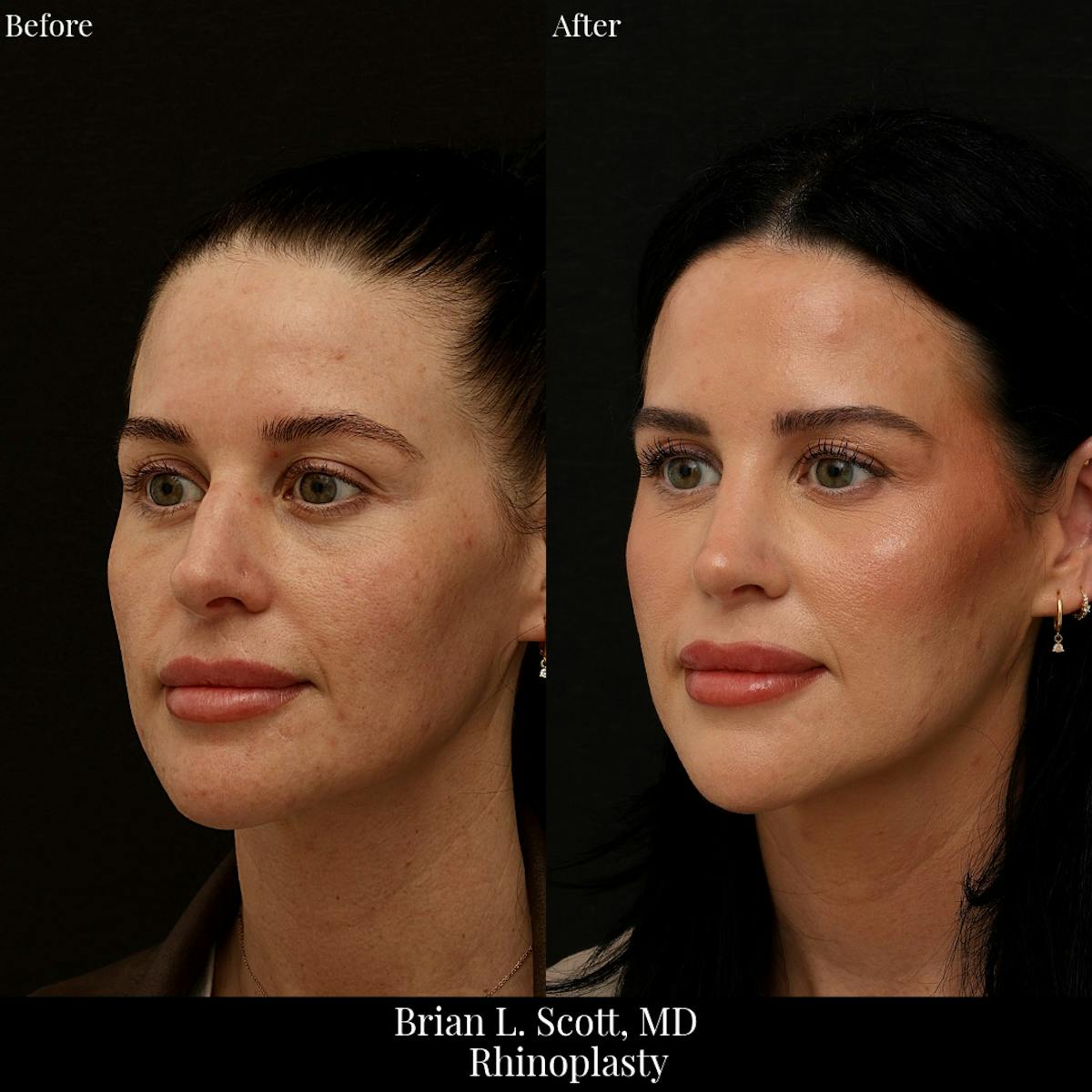 Rhinoplasty Before & After Gallery - Patient 279410 - Image 3