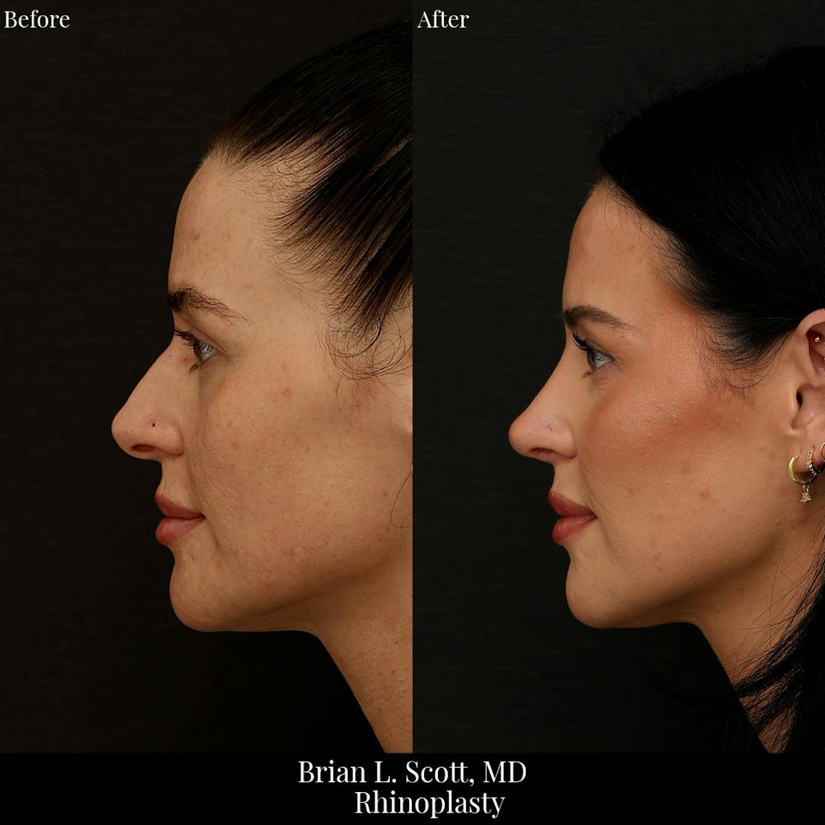 Rhinoplasty Before & After Gallery - Patient 279410 - Image 1