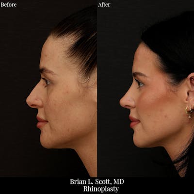 Rhinoplasty Before & After Gallery - Patient 279410 - Image 1