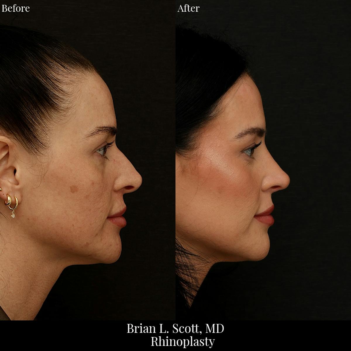 Rhinoplasty Before & After Gallery - Patient 279410 - Image 2