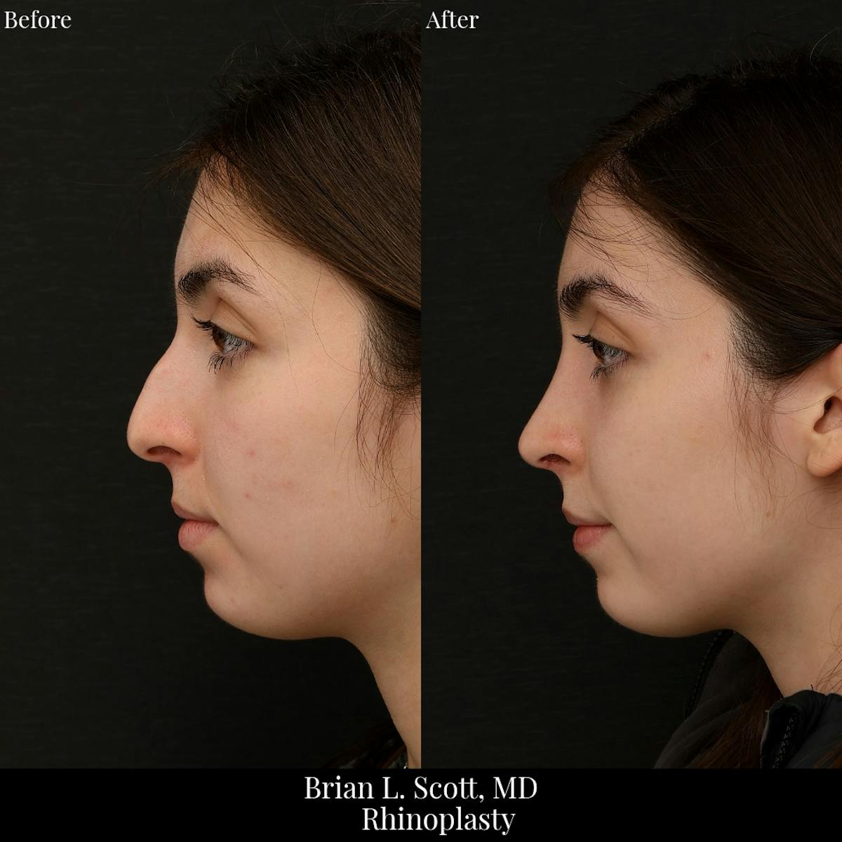 Rhinoplasty Before & After Gallery - Patient 101567 - Image 2
