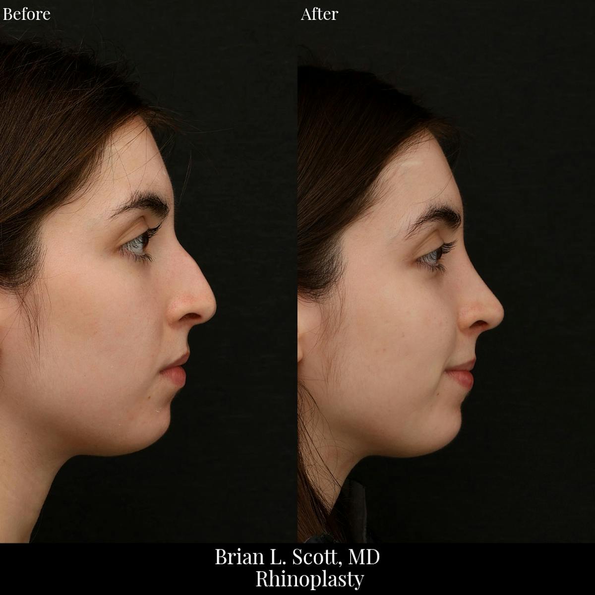 Rhinoplasty Before & After Gallery - Patient 101567 - Image 1