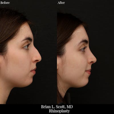 Rhinoplasty Before & After Gallery - Patient 101567 - Image 1