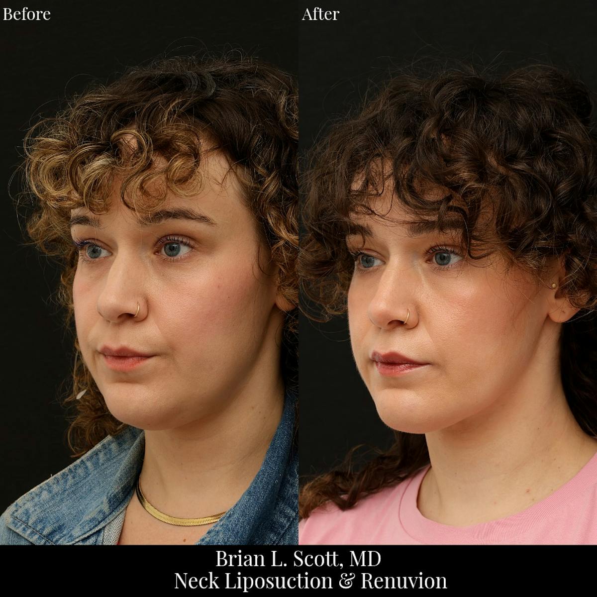 Neck Liposuction Before & After Gallery - Patient 249043 - Image 3
