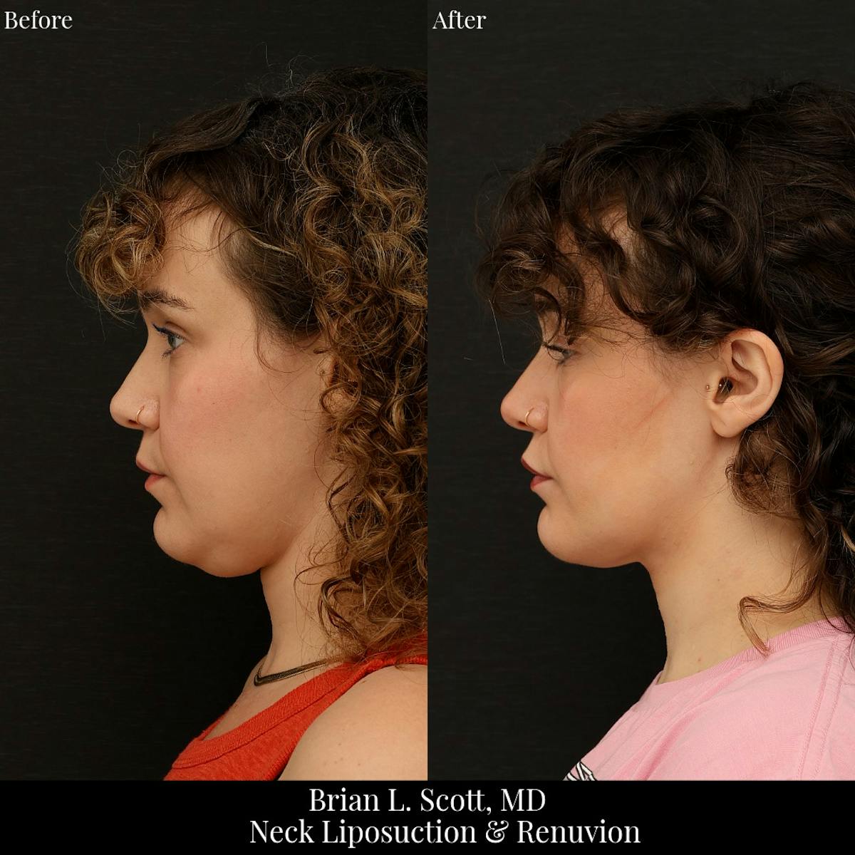 Neck Liposuction Before & After Gallery - Patient 249043 - Image 2
