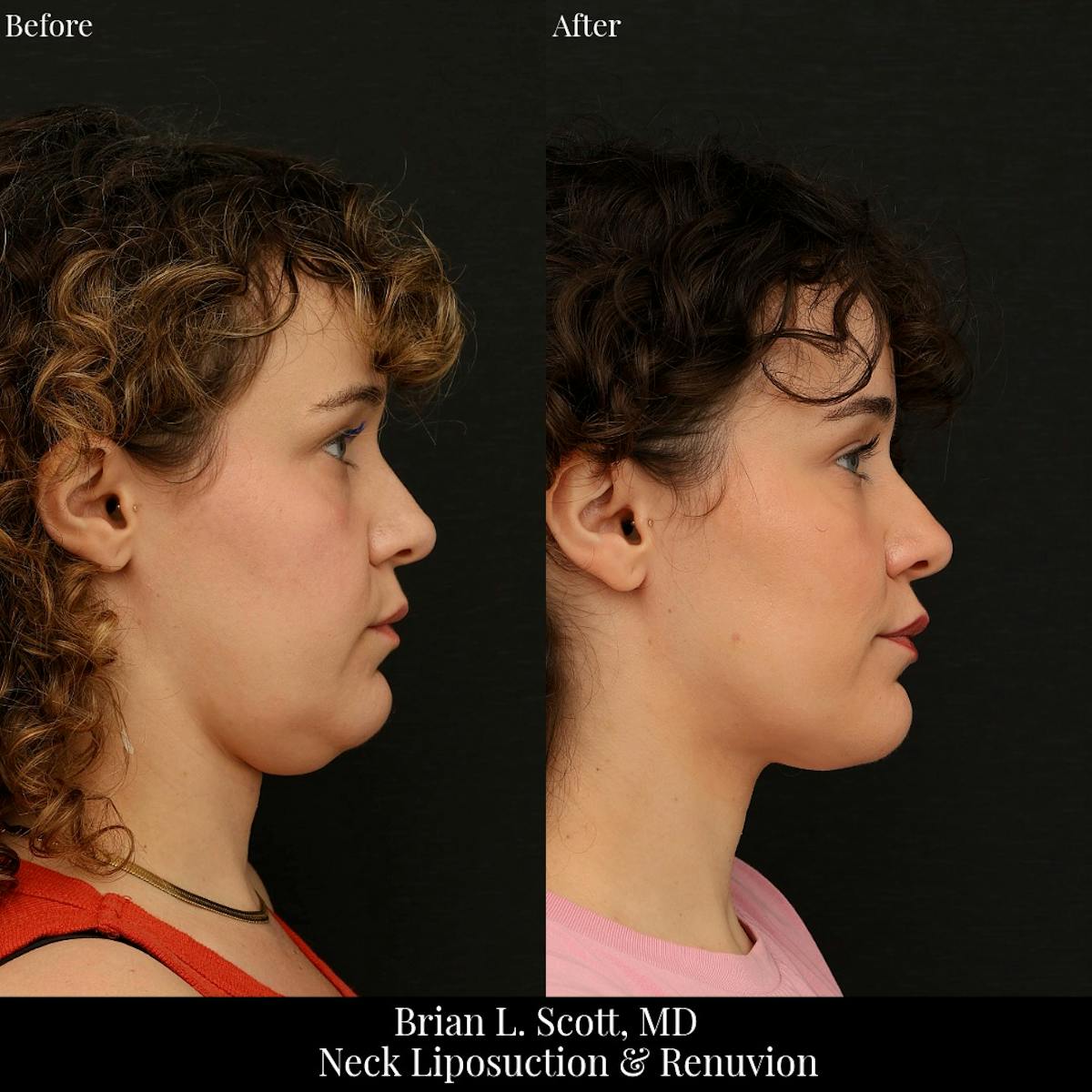 Neck Liposuction Before & After Gallery - Patient 249043 - Image 1