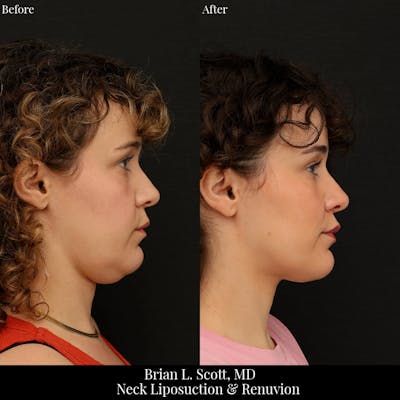 Neck Liposuction Before & After Gallery - Patient 249043 - Image 1