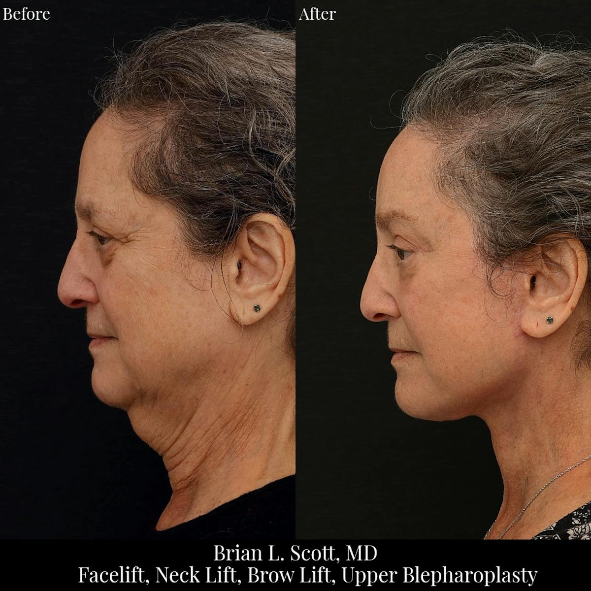 Facelift Before & After Gallery - Patient 330160 - Image 1