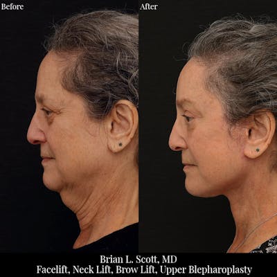 Neck Lift Before & After Gallery - Patient 142423 - Image 1